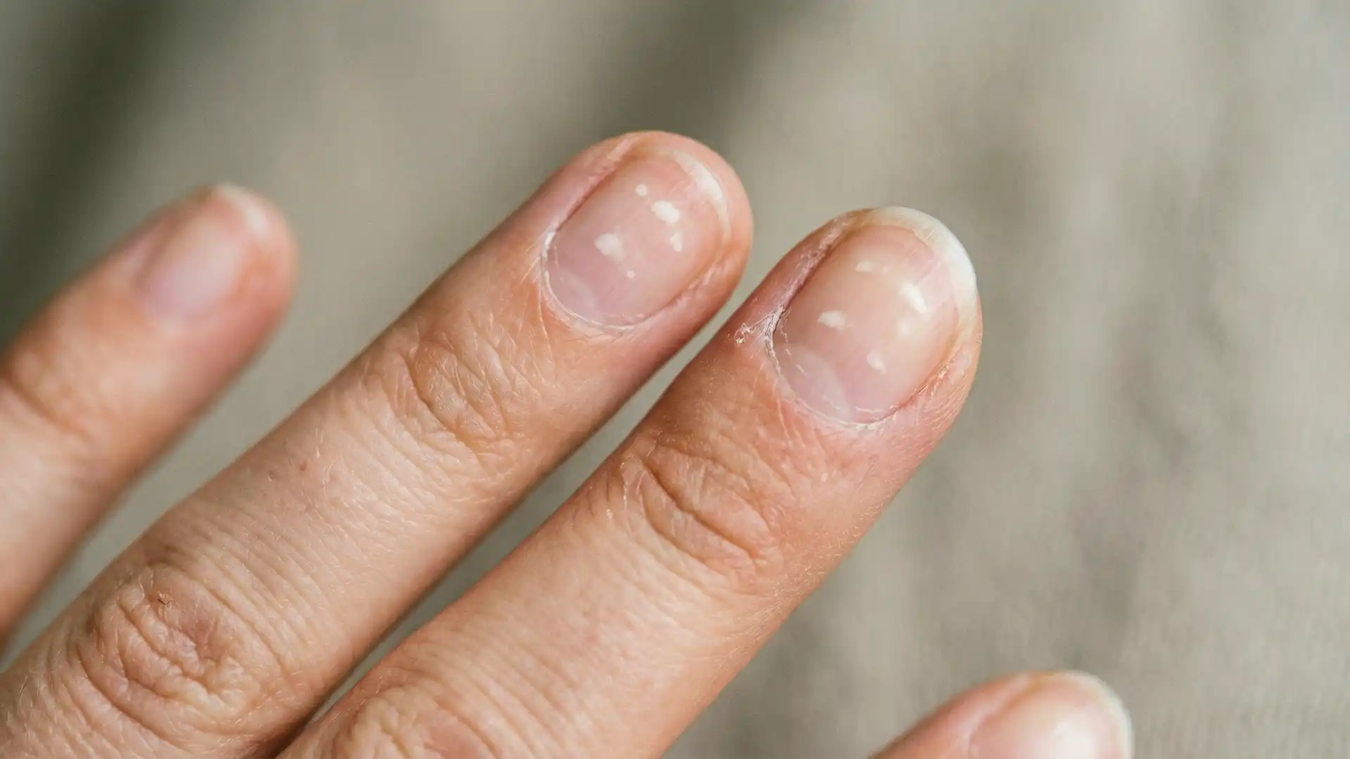 Close Up White Spots On Fingernails